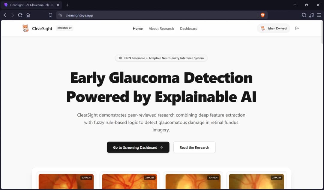 ClearSight | RAG-Powered Glaucoma Detection & Diagnostic Assistant